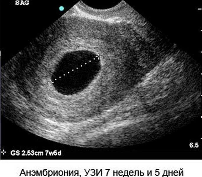 Почему не видно эмбрион