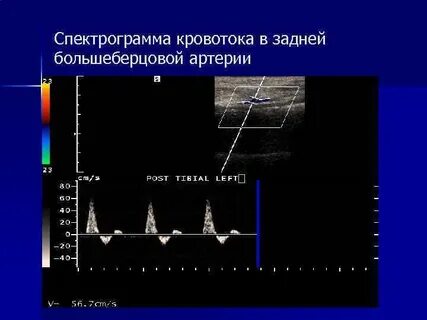 Виды кровотока в артериях