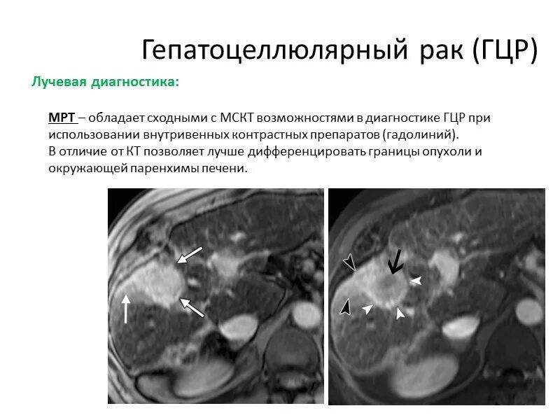 Гепатоцеллюлярная карцинома печени кт. Гепатоцеллюлярная аденома печени кт. Рак метастазы в печень лечение