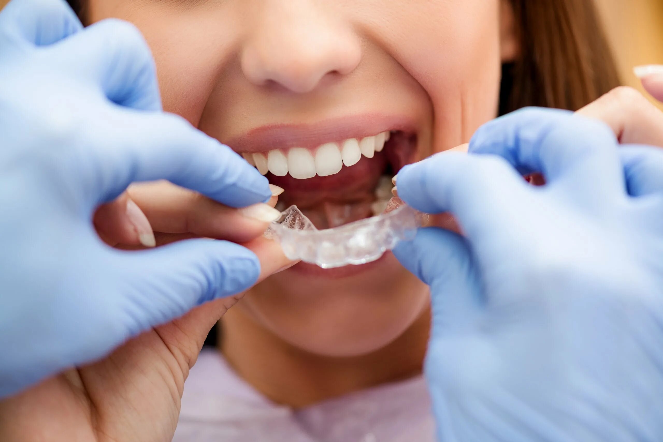 Что такое ортодонт. Ортодонт каппы элайнеры. Элайнеры Invisalign. Элайнерах Invisalign.