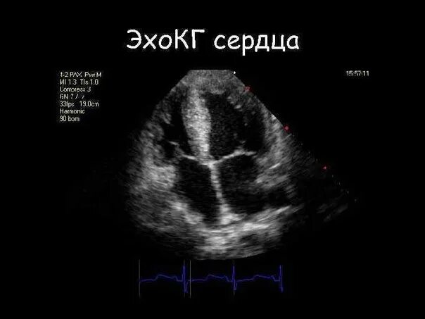Эх сердца. Узи сердца. эхокг сердца. ультразвуковое исследование сердца. эхокардиография сердца.