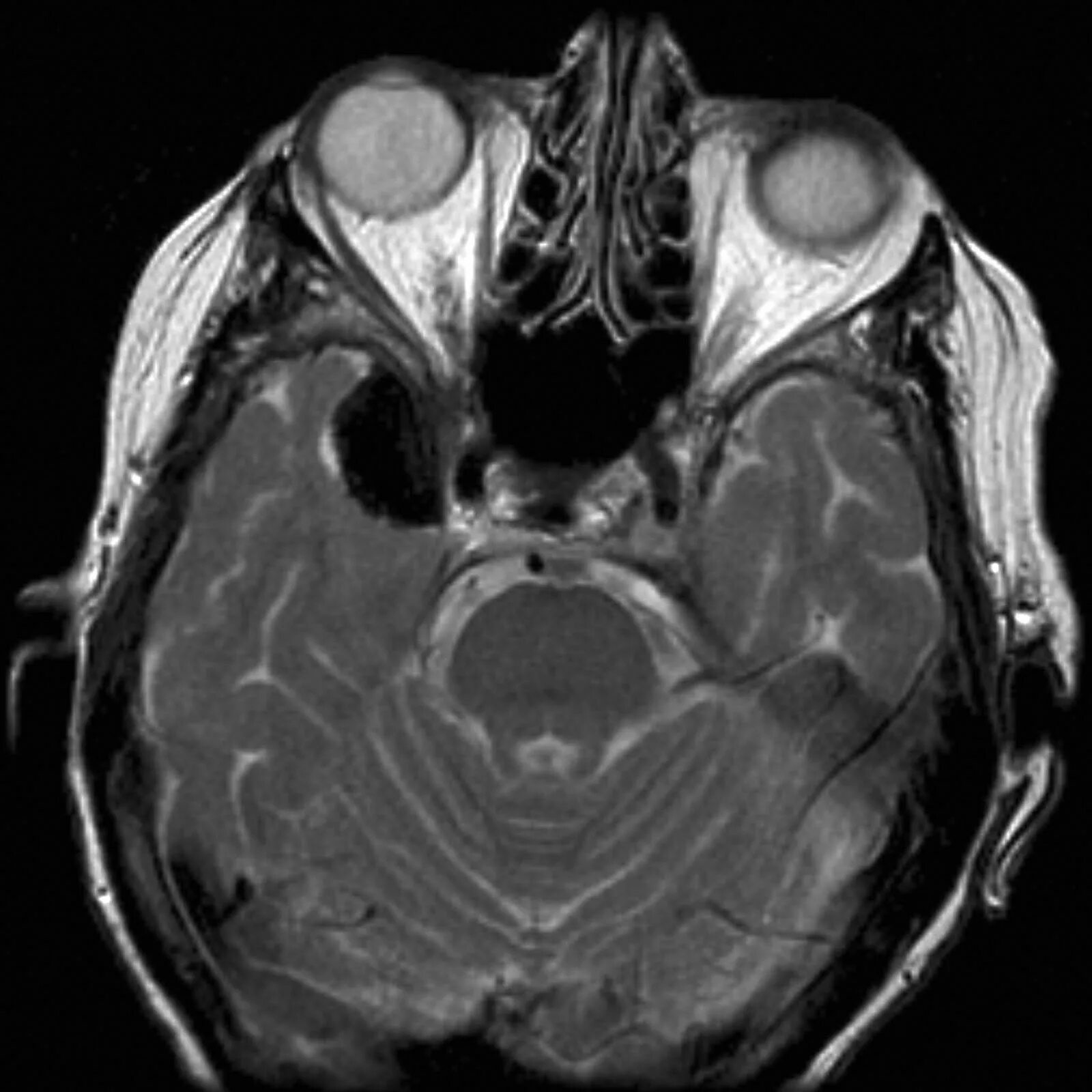 Мрт глазного нерва. Менингиома зрительного нерва мрт. Менингиома зрительного нерва кт. Мрт глазных орбит и зрительных нервов.