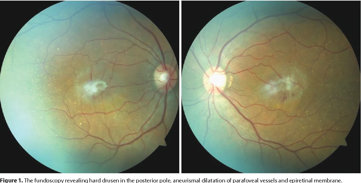 После операции сетчатки глаза ограничения. Эпиретинальный фиброз сетчатки глаза. Эпимакулярный фиброз глаза что это. Эпиретинальная мембрана (целлофановая макула). Эпиретинальный фиброз офтальмоскопия.
