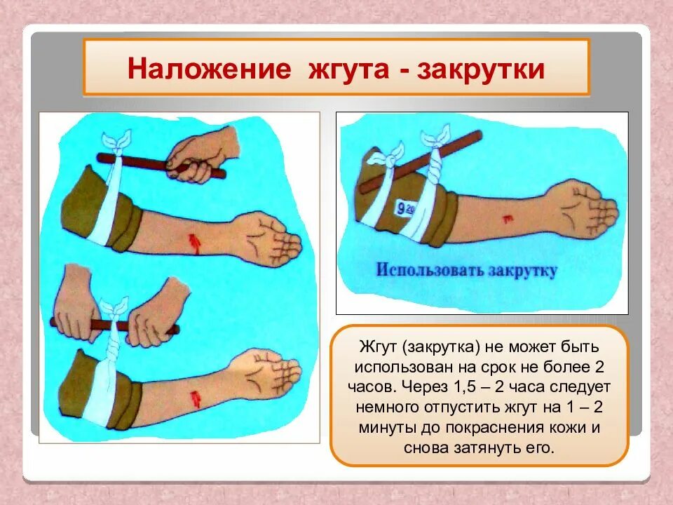 Наложение кровоостанавливающего жгута закрутки алгоритм. Техника наложения жгута кратко. Наолжение эгута закрутка. Наложение жгута накрутки.