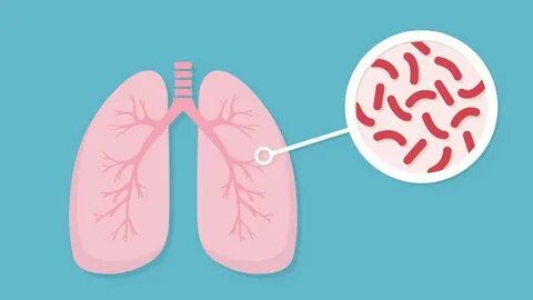 Tuberculosis