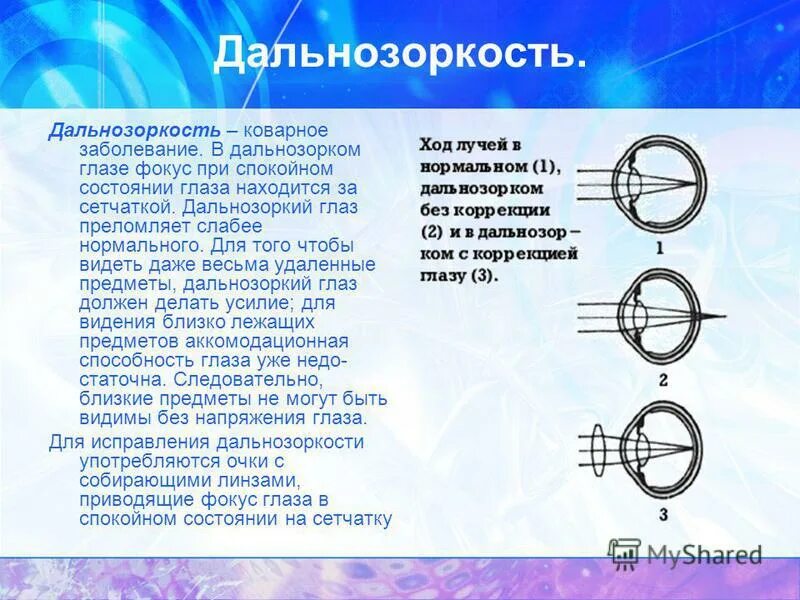 Сообщение на тему дальнозоркость. Дальнозоркость. дальнозоркость презентация. дальнозоркость доклад по физике. доклад на тему дальнозоркость по биологии.