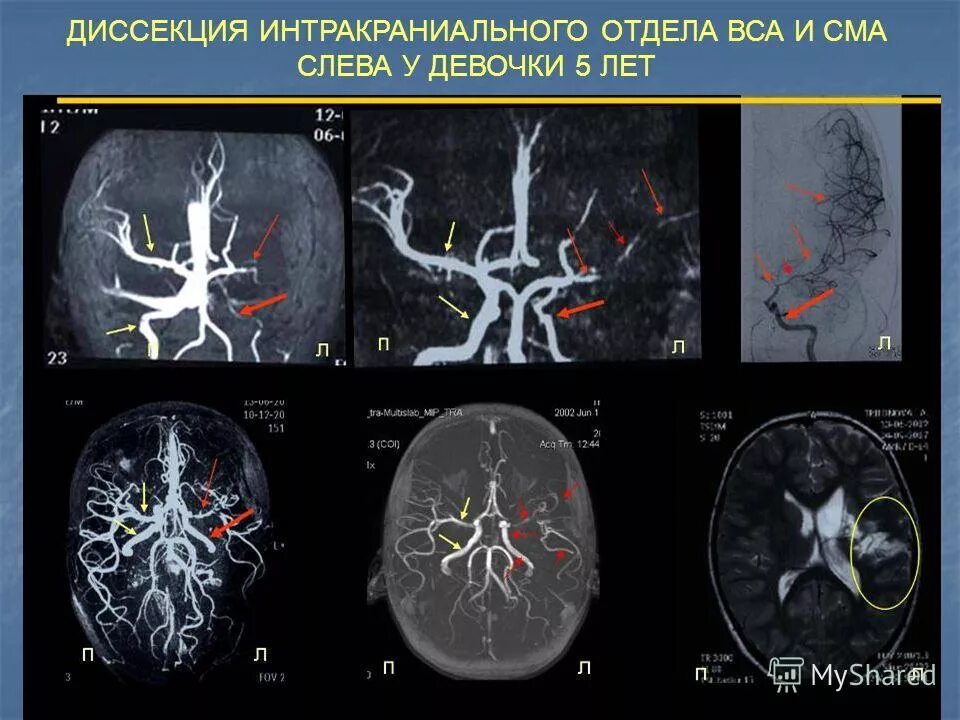 Интракраниальные артерии головного мозга. Диссекция позвоночной артерии на кт. Интрамуральная гематома внутренней сонной артерии. Диссекция внутренней сонной артерии кт. Фузиформное расширение основной артерии.