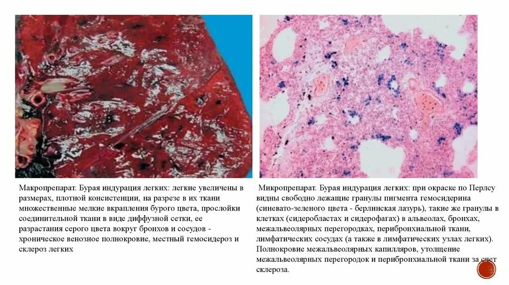 Бурая индурация легкого патоморфология. Бурая индурация легких макропрепарат. Бурая индурация легких макропрепарат. Бурая индурация легкого макропрепарат описание. Гемосидероз легкого патологическая анатомия.