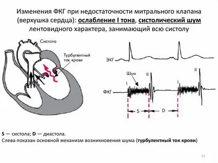 Шум при митральном стенозе
