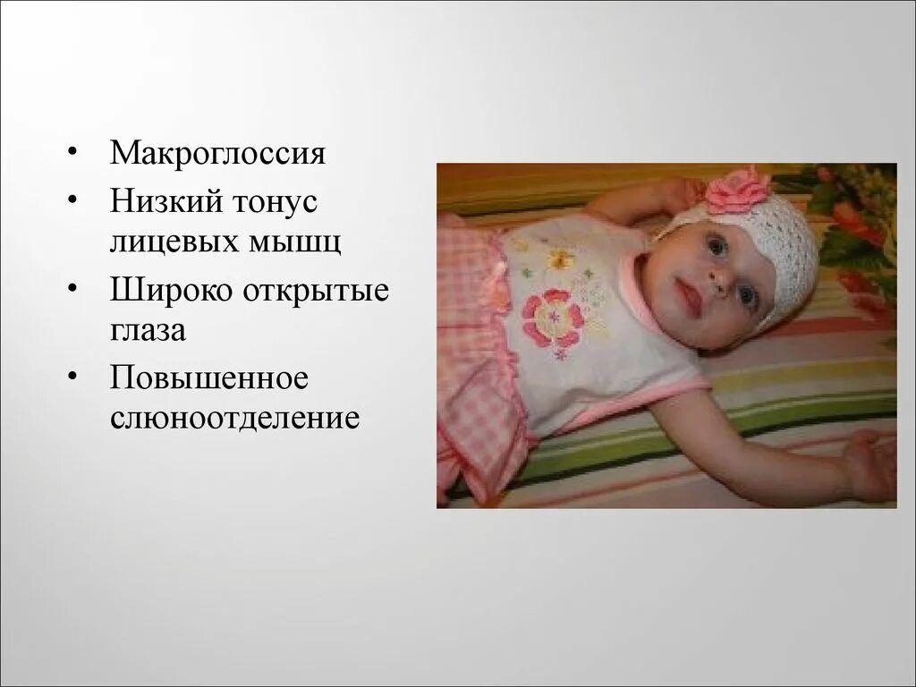 Болезнь помпе у детей. Болезнь помпе клинические проявления. болезнь помпе инфантильная форма.