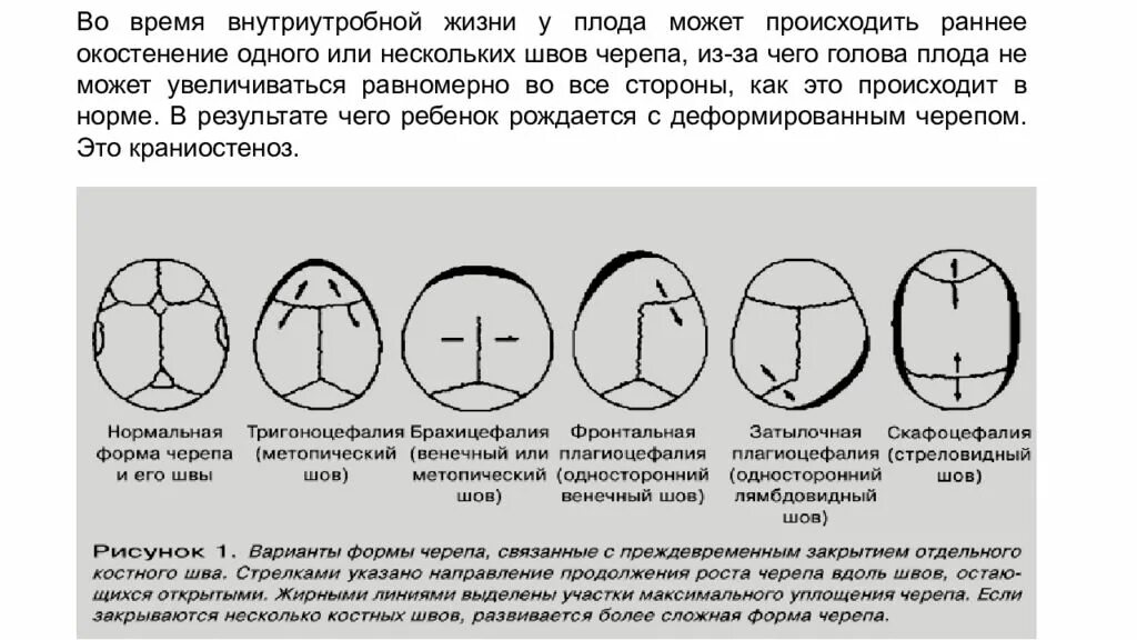 Стреловидный родничок. Стреловидный шов черепа у ребенка. Швы и роднички головки плода.