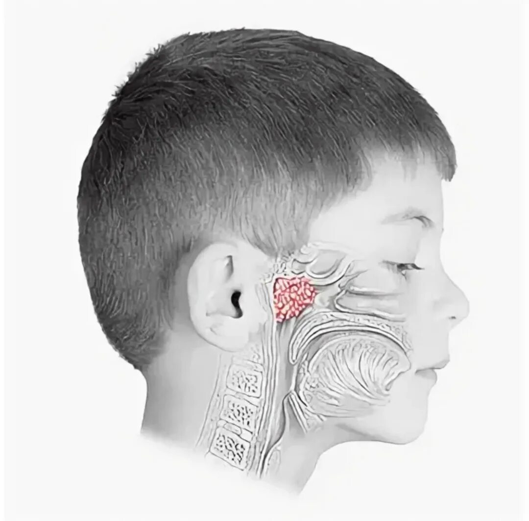Аденоиды признаки. Что такое аденоиды в носоглотке у ребенка.