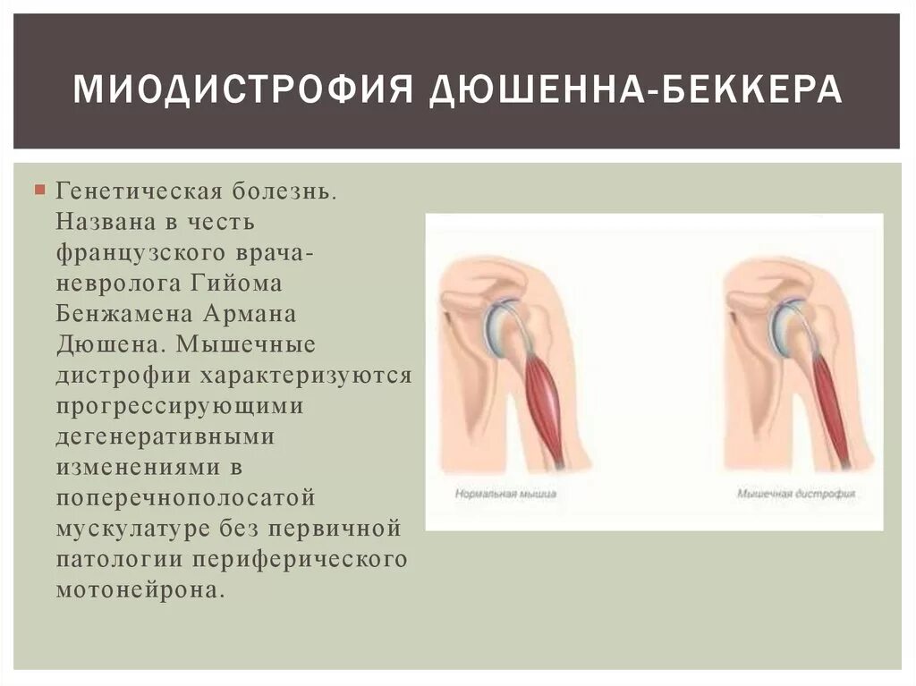 Миопатия беккера. Миодистрофия Дюшенна-Беккера. Мышечная дистрофия Беккера. Псевдогипертрофическая миодистрофия Дюшенна. Мышечная дистрофия Дюшенна Беккера.