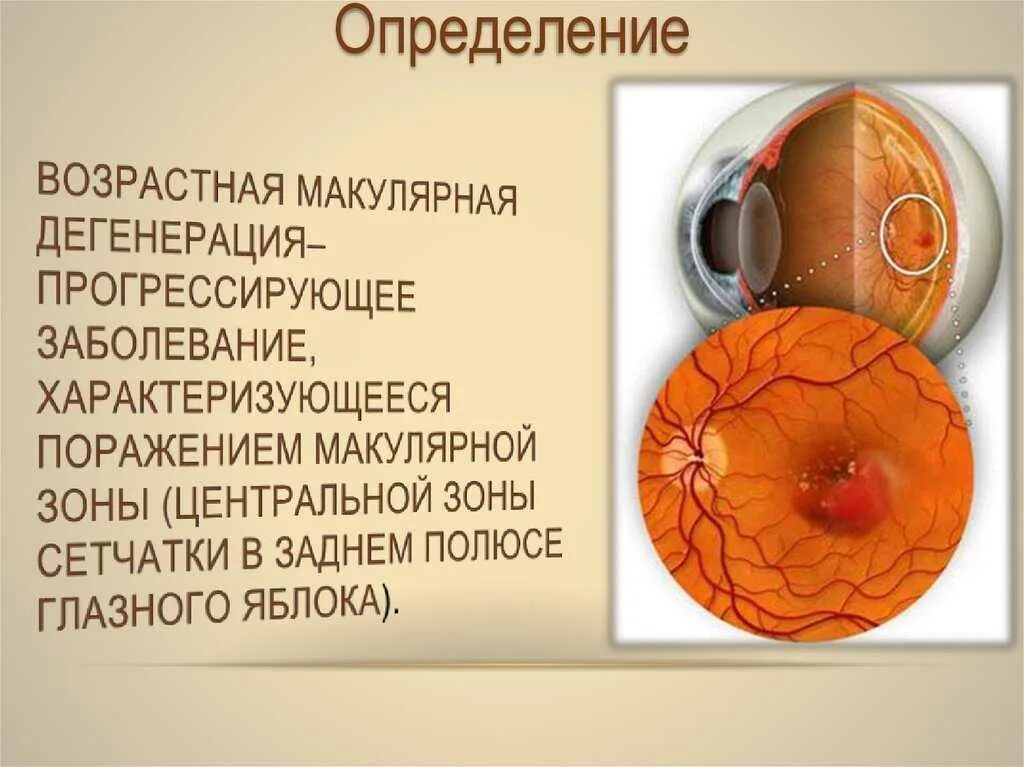 Макулодистрофия, макулярная дегенерация; ретинит;. Возрастная макулодистрофия глазное дно. Возрастная макулярная дегенерация глазное дно. Сухая форма центральной дистрофии сетчатки.