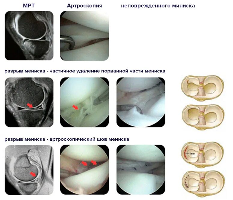 Горизонтальный разрыв медиального мениска. Разрыв мениска коленного операция. Повреждение заднего медиального мениска. Разрыв мениска операция мениска. Структурные изменения мениска