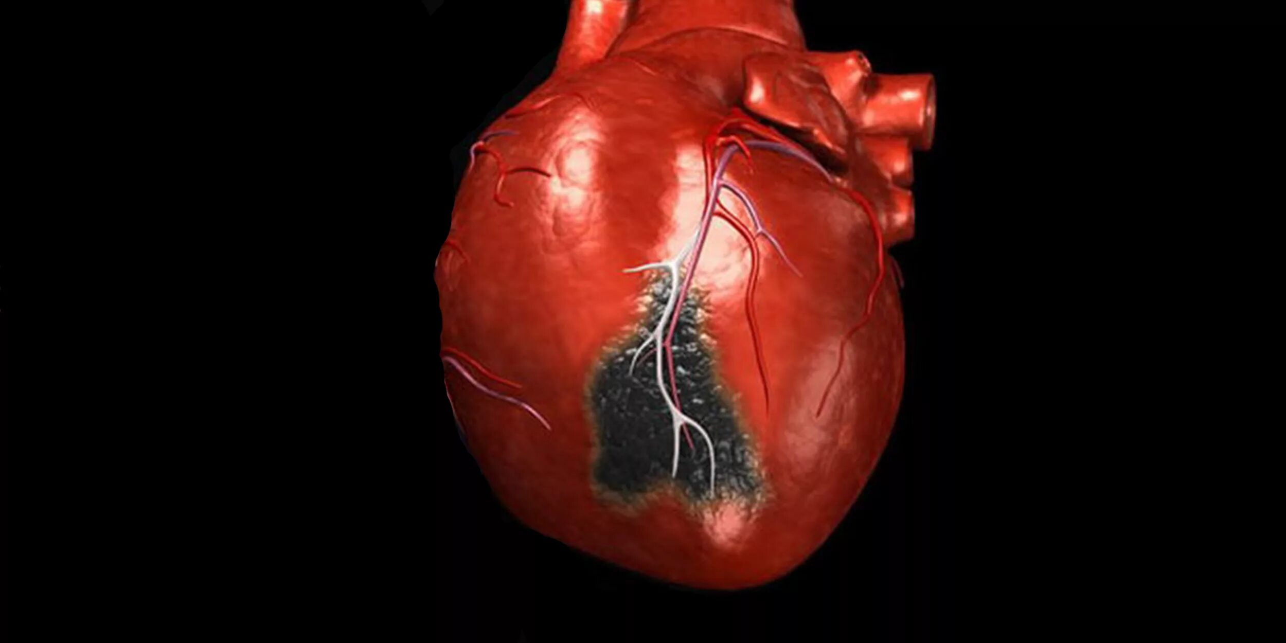 Осложнение на сердце после. Инфаркт миокарда (некроз миокарда). Инфаркт миокарда Юрский.