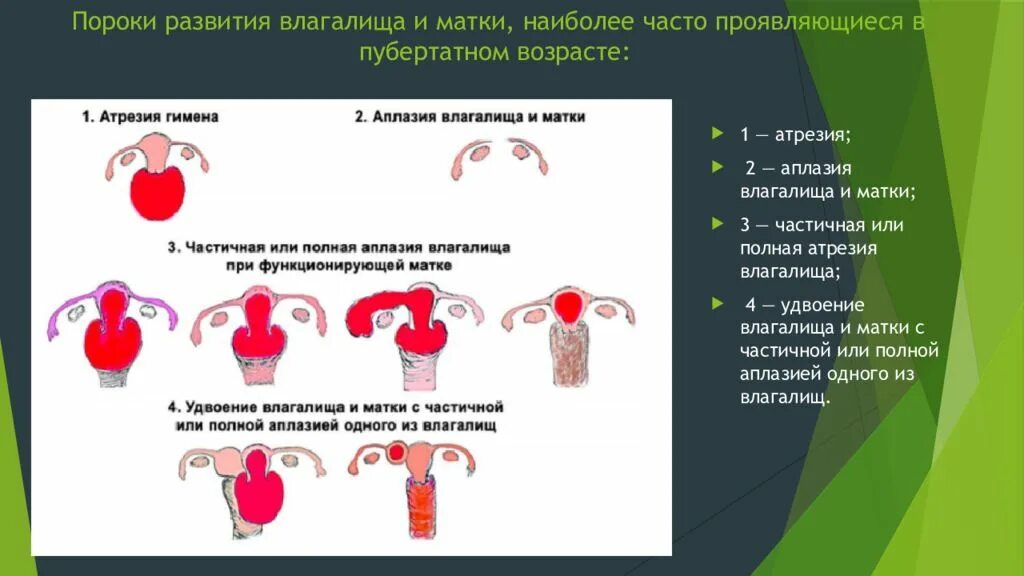 Пороки развития матки классификация. Врожденные патологии развития матки. Аномалии развития матки. Попороки развития матки. Что значит расширенная матка