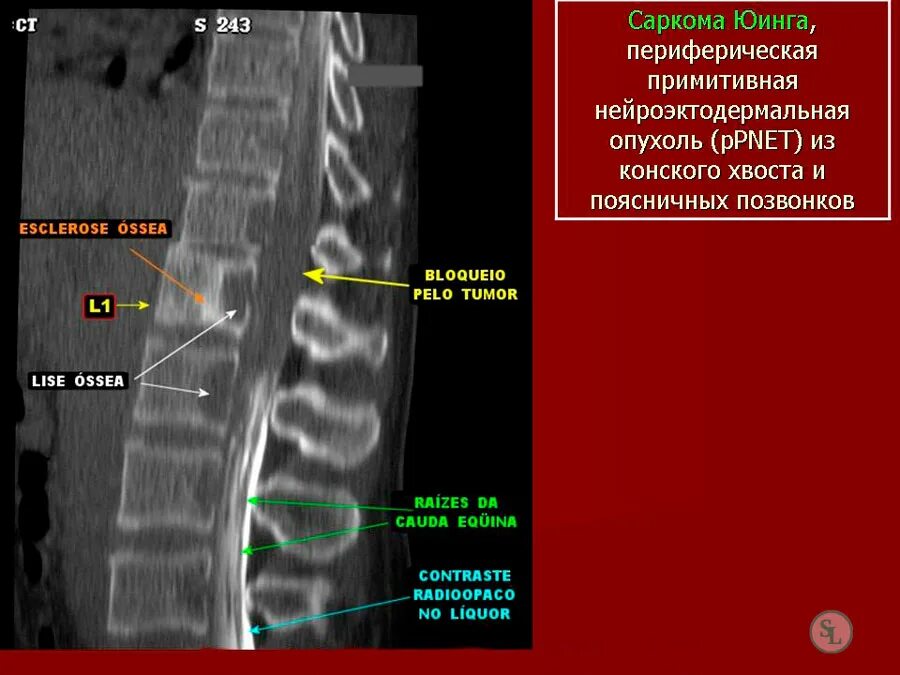 Рак поясницы. Опухоль грудного позвонка рентген. Опухоль позвонка грудного отдела. Остеосаркома тела позвонка.