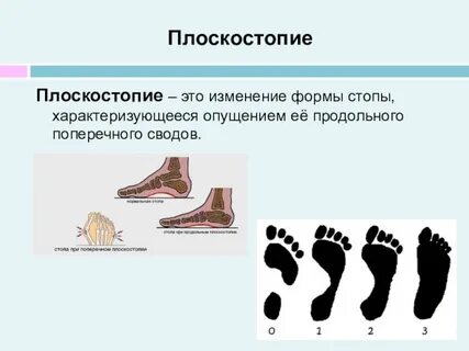 Продольное плоскостопие это