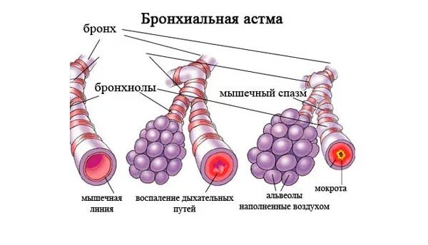 Bronchial asthma. Воспаление дыхательных путей при бронхиальной астме. Альвеолы при астме. Альвеолы при бронхиальной астме. Гладкая мускулатура бронхов.