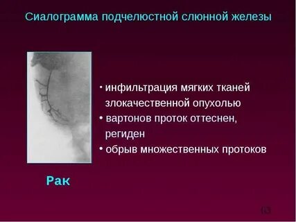 Опухоли слюнных желез