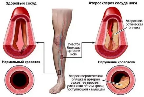 Сосуды нижних конечностей лечение у женщин