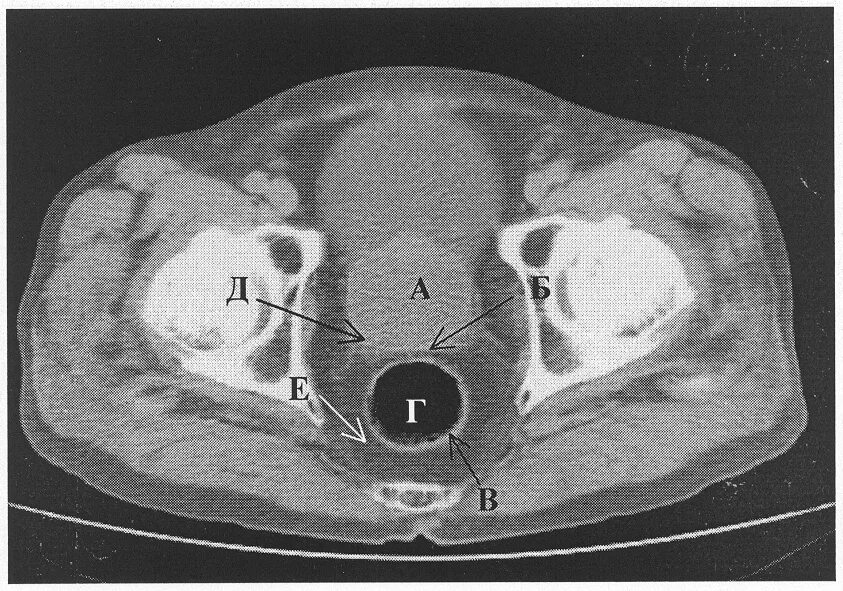 ЗНО предстательной железы на кт. Предстательная железа на томограмме. Аденома предстательной железы на кт. Аденома простаты мрт