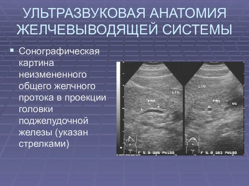 Ультразвуковая анатомия желчного пузыря. Расширение желчного протока на УЗИ. Желчные протоки на УЗИ норма. Расширение общего желчного протока на УЗИ. Холедох печени норма