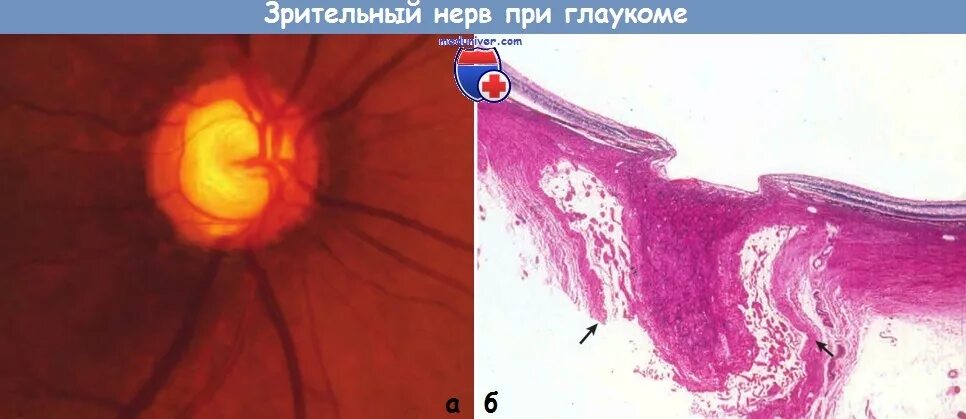 Зрительный нерв при глаукоме. Глаукоматозная экскавация зрительного нерва. Диск зрительного нерва при глаукоме. Экскавация диска зрительного нерва при глаукоме. Изменения зрительного нерва при глаукоме.