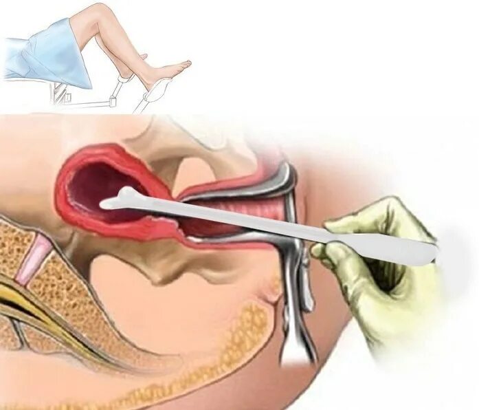 Выскабливание зачем. Выскабливание полости матки. Раздельное диагностическое выскабливание. Аспирационная биопсия эндометрия. Вакуум-аспирация эндометрия.