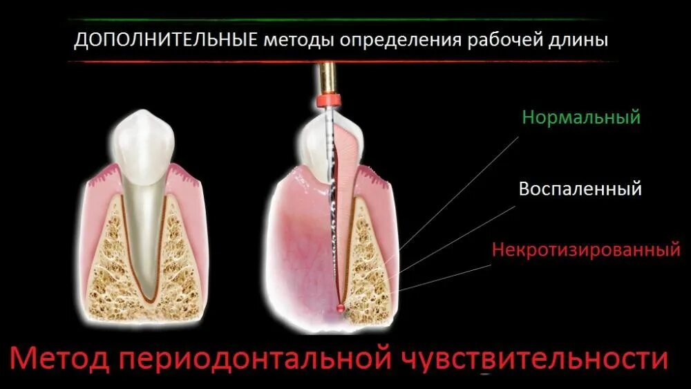 Определение корневых каналов. Измерение длины корневого канала. Табличный метод определения длины корневого канала. Измерение длины канала зуба. Методы определения рабочей длины корневого канала.