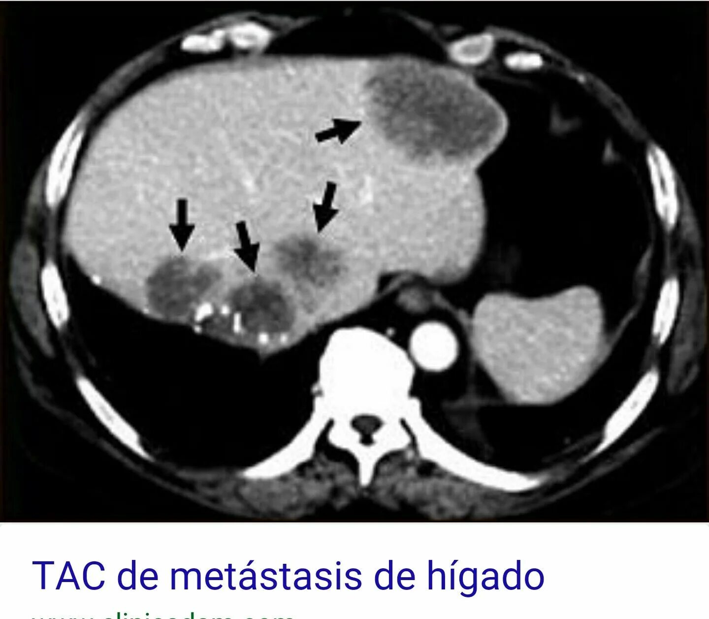 Метастазы при раке щитовидной железы. Аденокарцинома печени кт. Метастазы в печени на ПЭТ кт.
