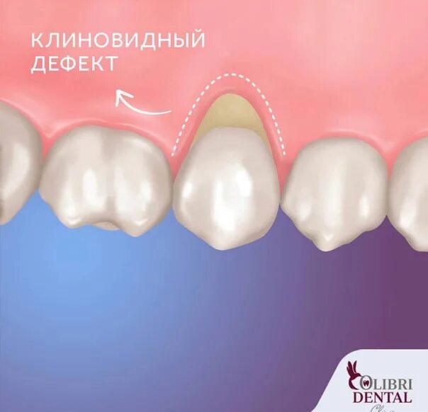 Пришеечный кариес пломба. Клиновидный причины. Пришеечного кариеса (клиновидный дефект. Пришеечный клиновидный дефект. Klinavidni deffekt zuba.