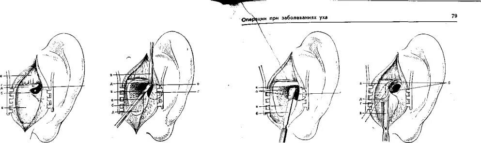 Операция на среднем ухе. Радикальная общеполостная операция. Общеполостная санирующая операция на ухе. Радикальная операция уха. Полость после Радикальной операции на ухе.