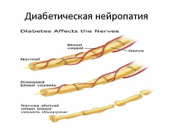 Диабет невропатия. Нейропатия сахарного диабета. Деабетическаянейропатия. Диабетическая периферическая нейропатия. Диабетическая нейропатия стадии.