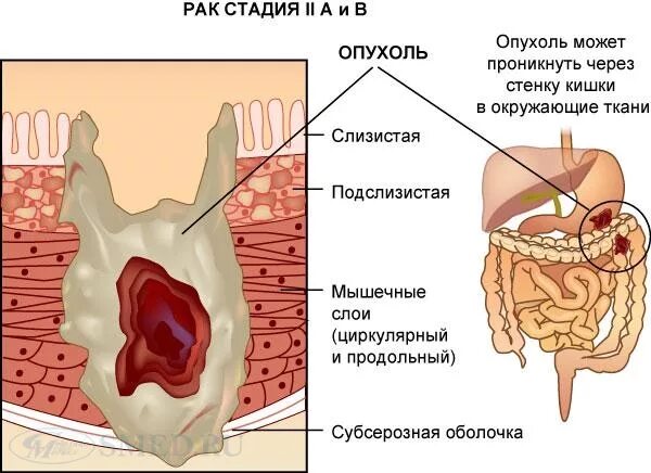 Симптомы рака кишки. Новообразования в прямой кишке. Опухоль прямой кишки симптомы. Злокачественное новообразование прямой кишки.