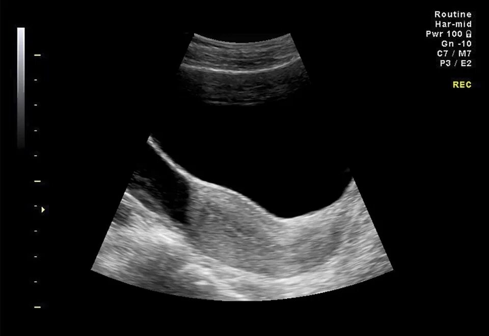 Серозоцеле в малом тазу на узи. Серозоцеле в малом тазу на узи. Внутривагинальное узи. Мезотелиома малого таза мрт. Аднексит яичника узи снимок.