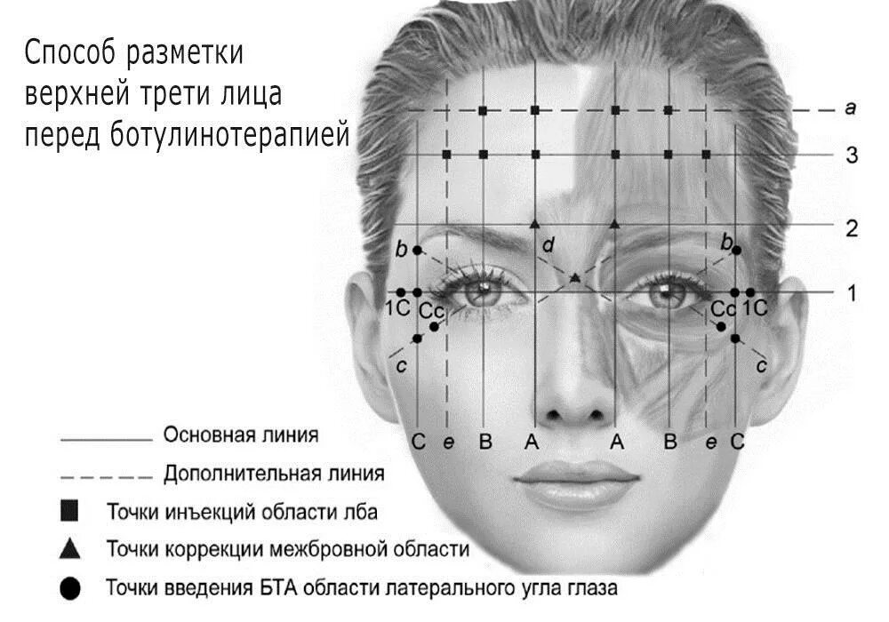 Точки ботулотоксина укола схема. Мезоботокс точки введения. Схема введения ботулотоксина в лоб. Точки уколов ботокса на лице схема.