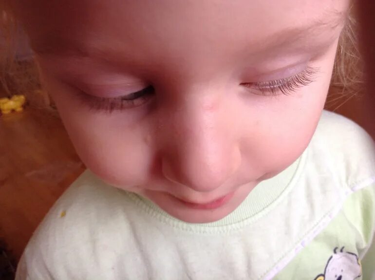 Широкая переносица у младенца. Синяя вена на переносице у грудничка. Широкая переносица у ребенка. Венка на переносице у ребенка. Венка на переносице у ребенка.
