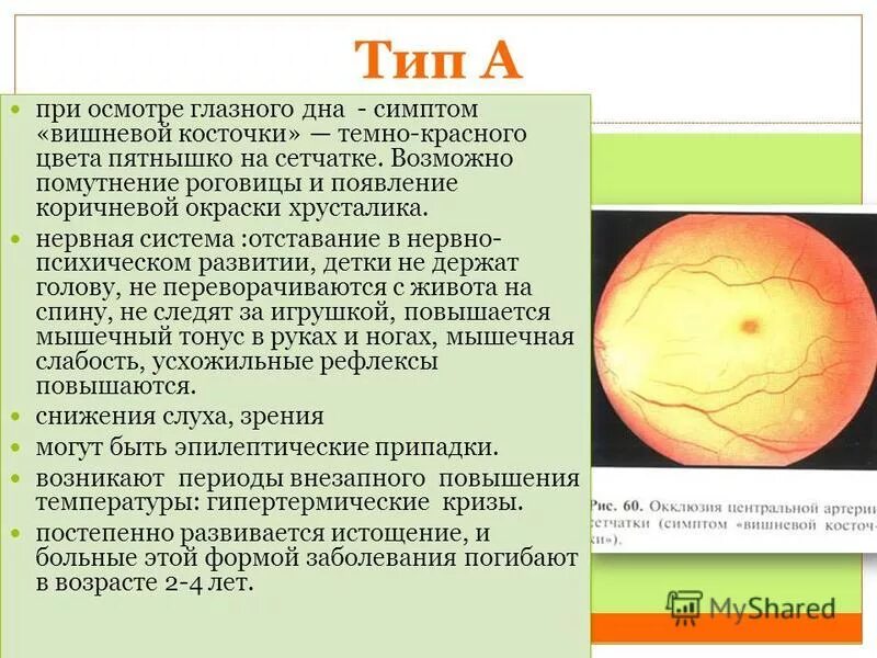 Болезнь глазного дна. Симптом вишневой косточки. Симптом вишневой косточки на глазном дне. Вишневая косточка симптом. Синдром вишневой косточки.