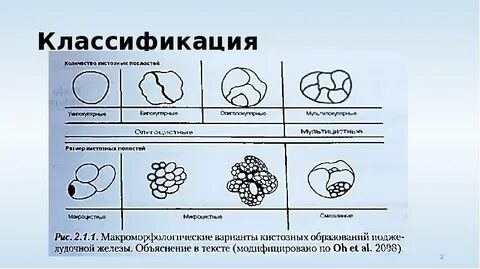 Киста простаты