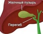 Перетяжка желчного пузыря симптомы. Перекрут и загиб желчного пузыря. перекрученный желчный пузырь. деформация желчного пузыря перегибом. деформированный желчный пузырь с перегибом.