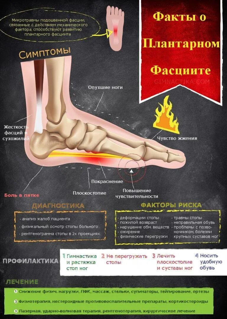 Подошвенный фасциит что это такое. Подошвенный (плантарный) фасциит. Плантарный фасциит лечебная гимнастика. Подошвенный фасциит упражнения.