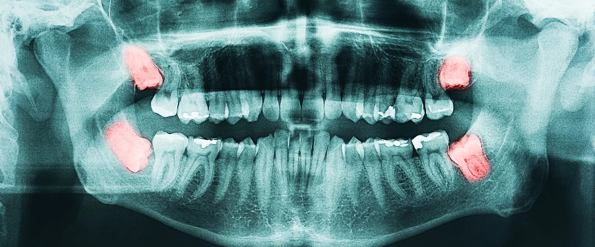 Сложное удаление зуба. Ретинированный дистопированный зуб мудрости. Ретинированный зуб мудрости снимок. Ретинированный зуб рентген.