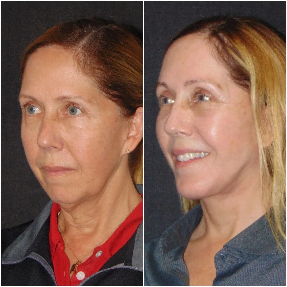 Deep lifting. Аксесс фейслифт. фейслифт аксесс фото до и после. deep plane facelift.