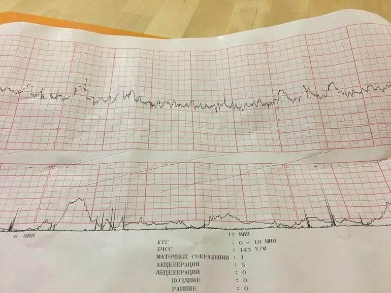 Схватки хиггса. КТГ при беременности при схватках. Как на КТГ показывает схватки. Показатель схваток на КТГ. Как выглядят схватки на КТГ.