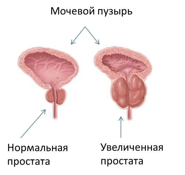 Воспалить простату. Аденома простаты клиника. Простата у мужчин. Аденома предстательной железы мкб.