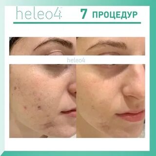 Heleo4 москва