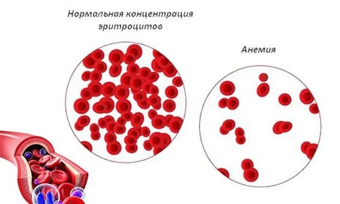 Анемия в детском возрасте. Железодефицитная анемия эритроциты дети. Жда у детей. Железодефицитная анемия у детей старшего возраста. Профилактика железодефицитной анемии у детей раннего возраста.