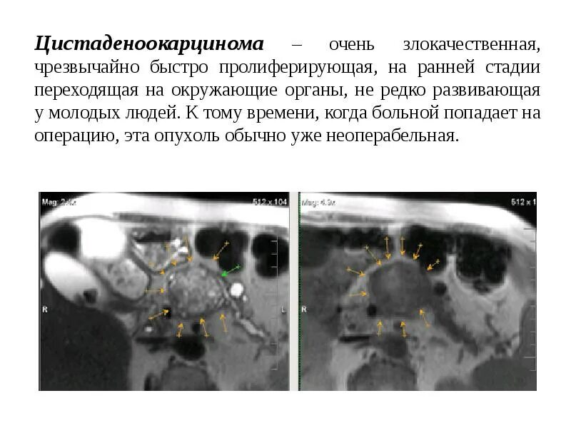 Рак неоперабельный 4 стадия